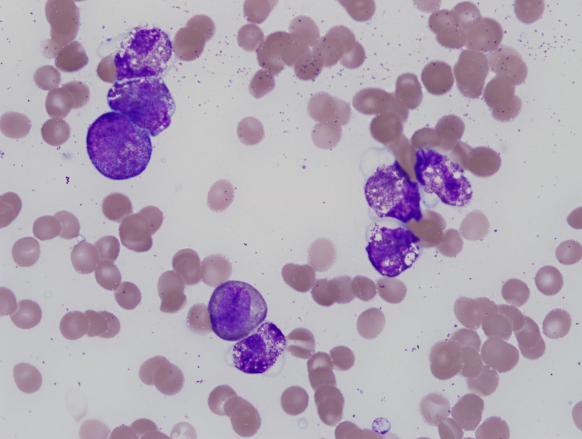 BM biopsy 1 direct smear 100x